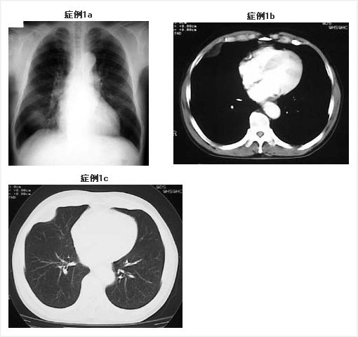 胸部異常陰影