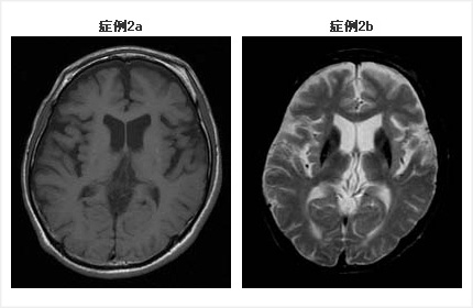 頭部MRI