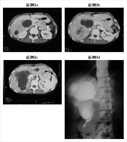 腹部造影CT、ERCP