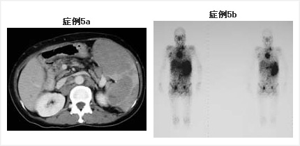 腹部CTとGaシンチ