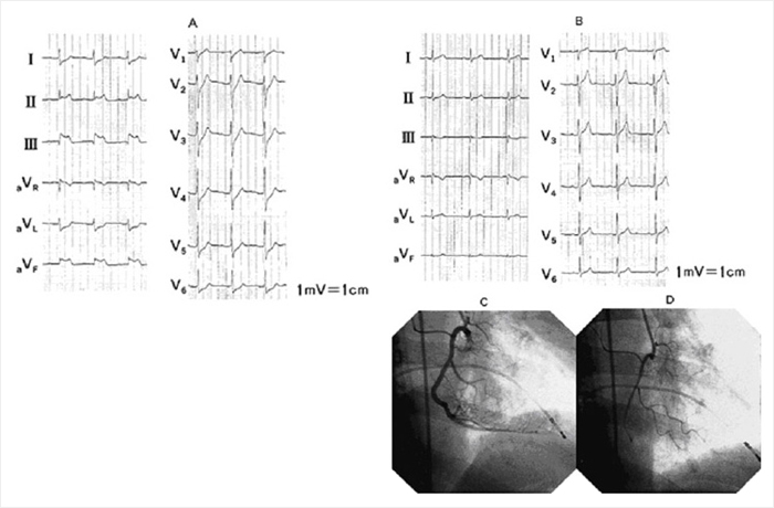 冠動脈内アセチルコリン負荷時の右冠動脈造影写真