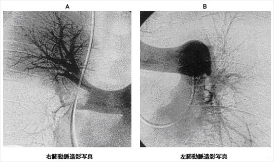 肺動脈ディジタルサブトラクション血管造影〈DSA〉写真